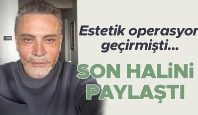 Estetik operasyon geçirmişti… Son halini paylaştı