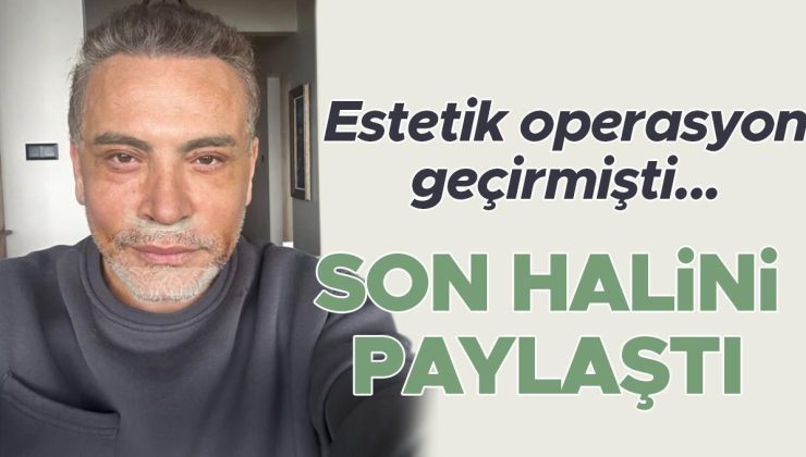 Estetik operasyon geçirmişti… Son halini paylaştı