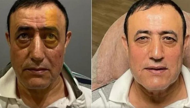 Mahmut Tuncer de estetik operasyon geçirdi